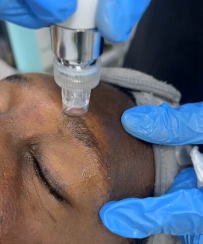 Micro Needing Facial