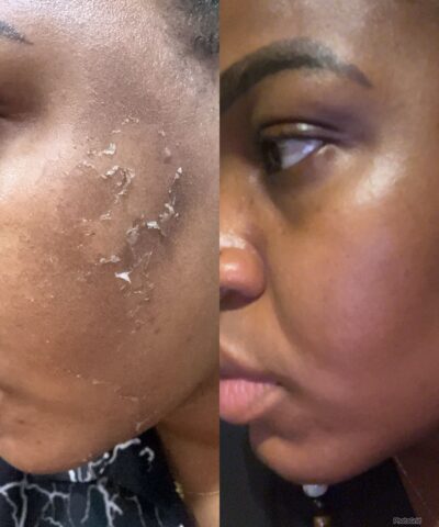 Chemical Peel Facial